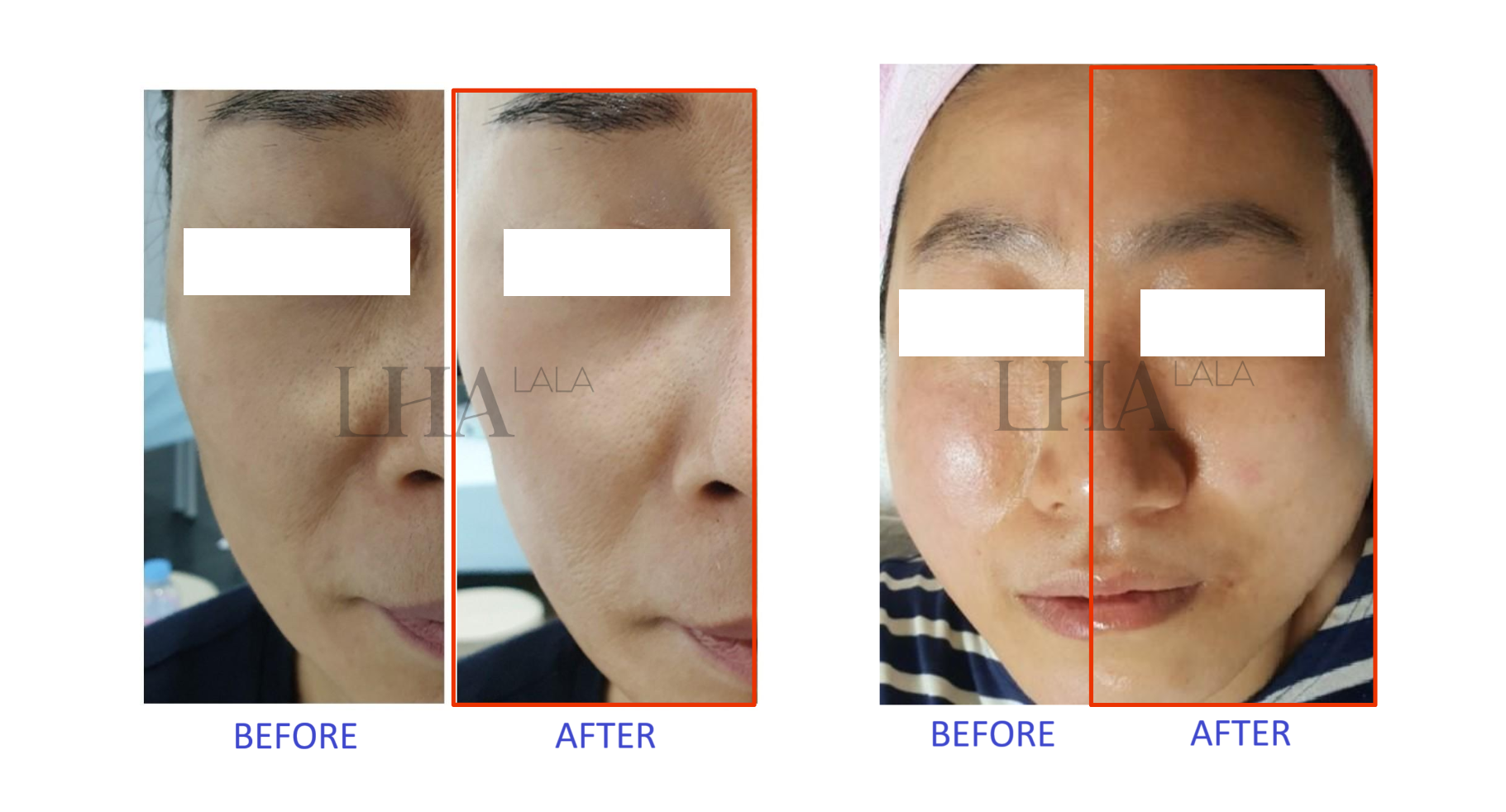 LHAlala peel before and after effect 1