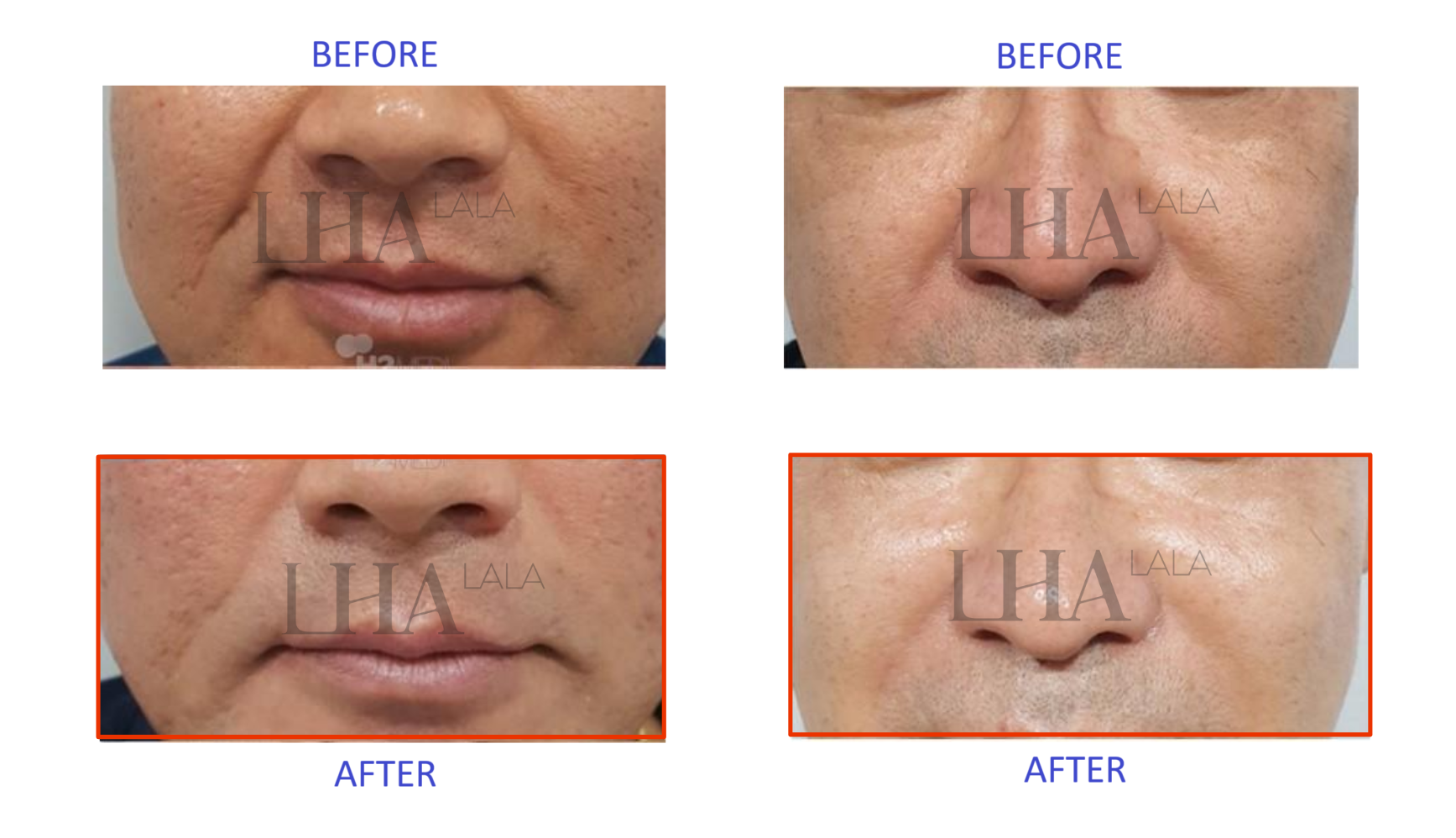 LHA lalapeel before and after 2