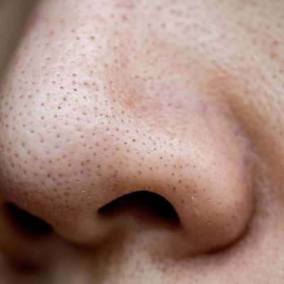 如何正確清粉刺？面膜、酸類、妙鼻貼各種去、拔粉刺方法推薦-泥膜-2-1180x700